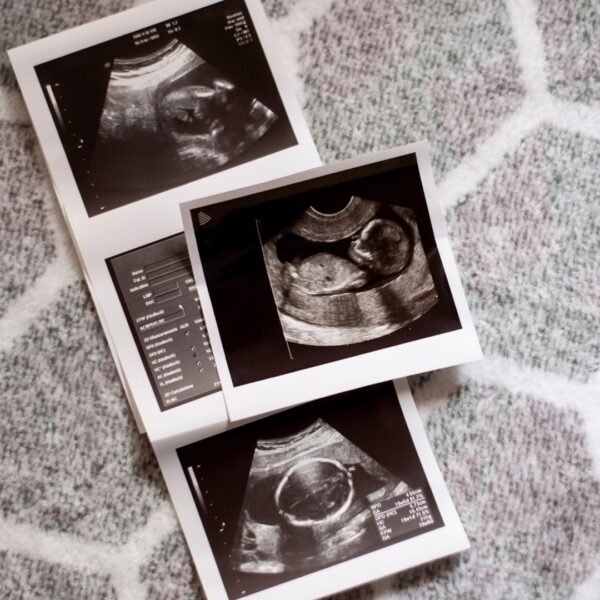 First trimester Nuchal Translucency Ultrasound (11-13 weeks)