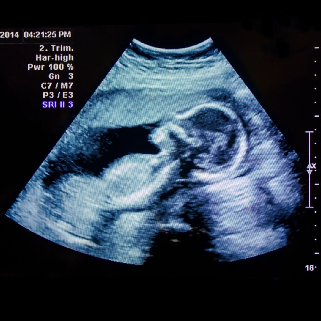 Biophysical scoring (28-42 WEEKS)