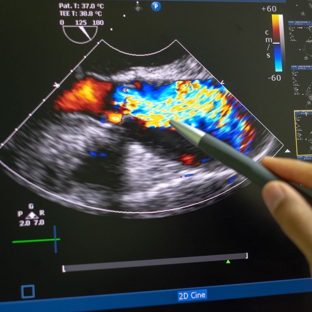 Gyne doppler (IOTA / MUSA /IETA)