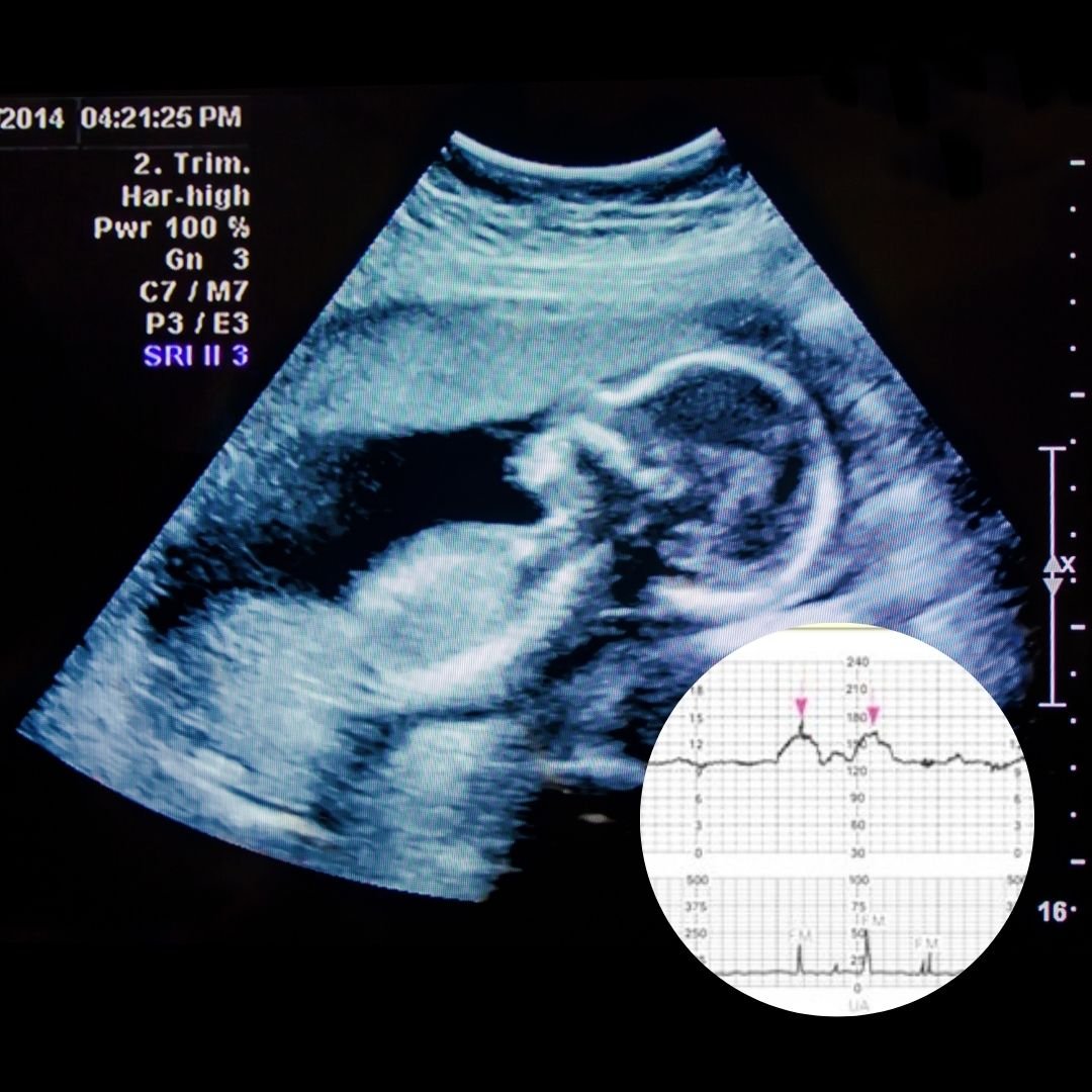 Biophysical scoring with non-stress testing